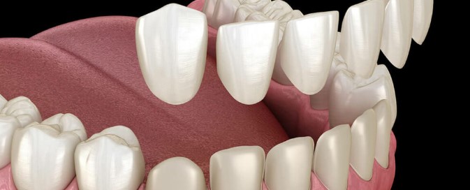 Transform Your Smile: The Complete Guide to Dental Veneers